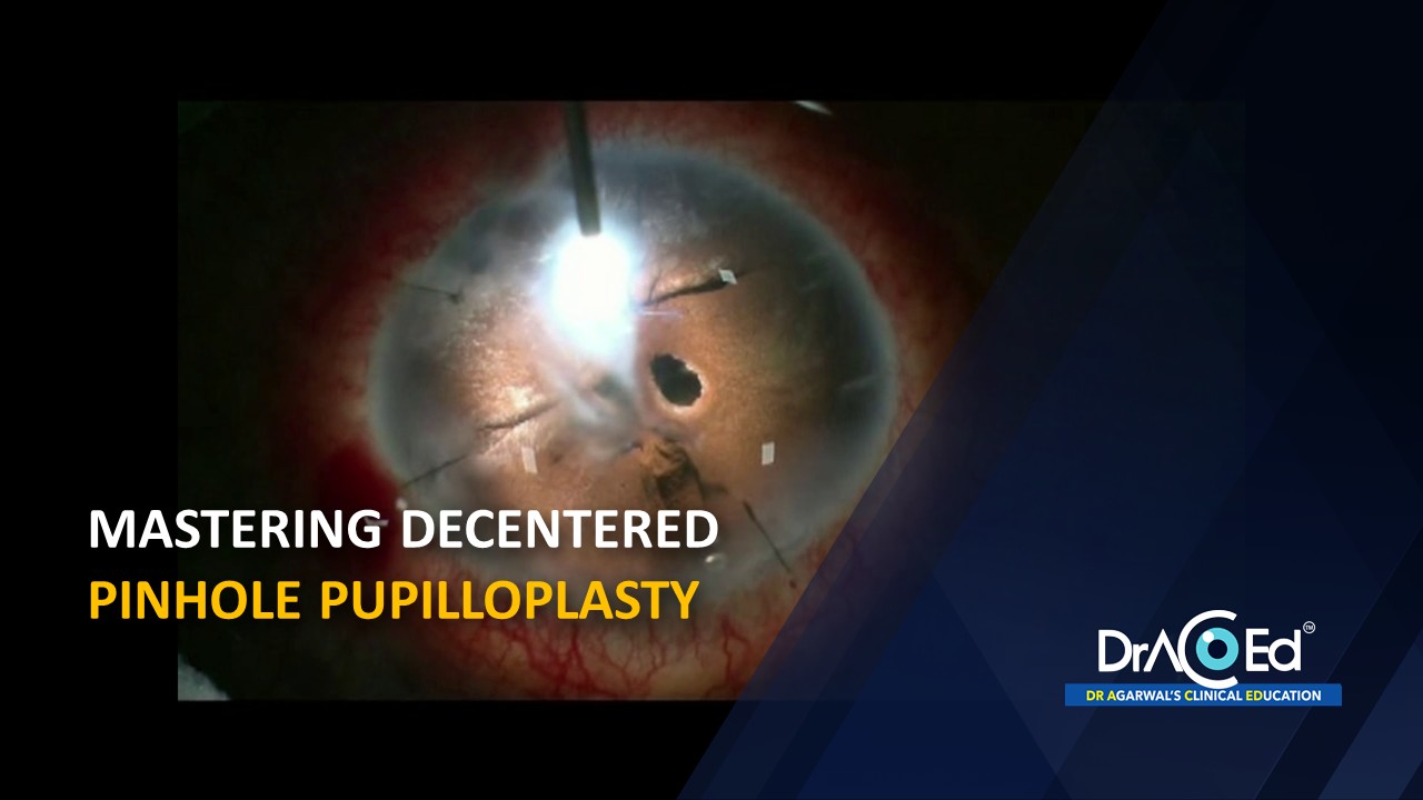 Mastering Decentered Pin hole Pupilloplasty 